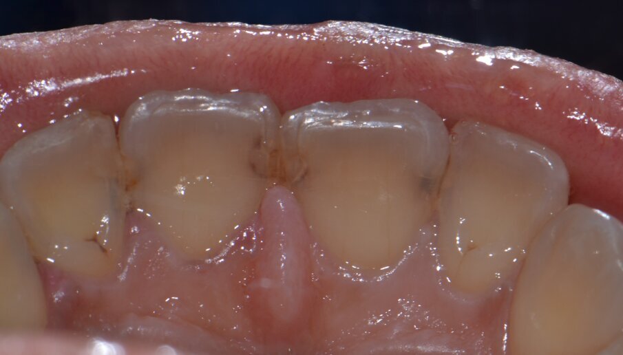Fig 2: incisal attrition and proximal caries with upper anterior teeth