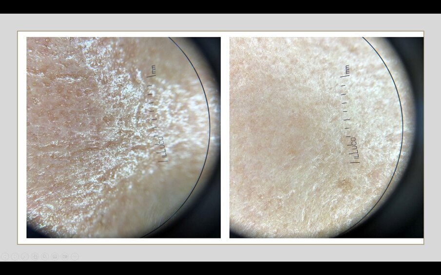 Fig. 2 - Fig. 2 - Modifica della texture cutanea dopo trattamento con needling-RF e esosomi: immagine al dermatoscopio.