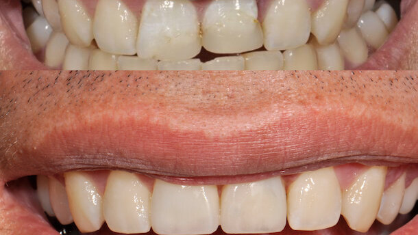 Las ventajas de la restauración con un sistema de color inteligente