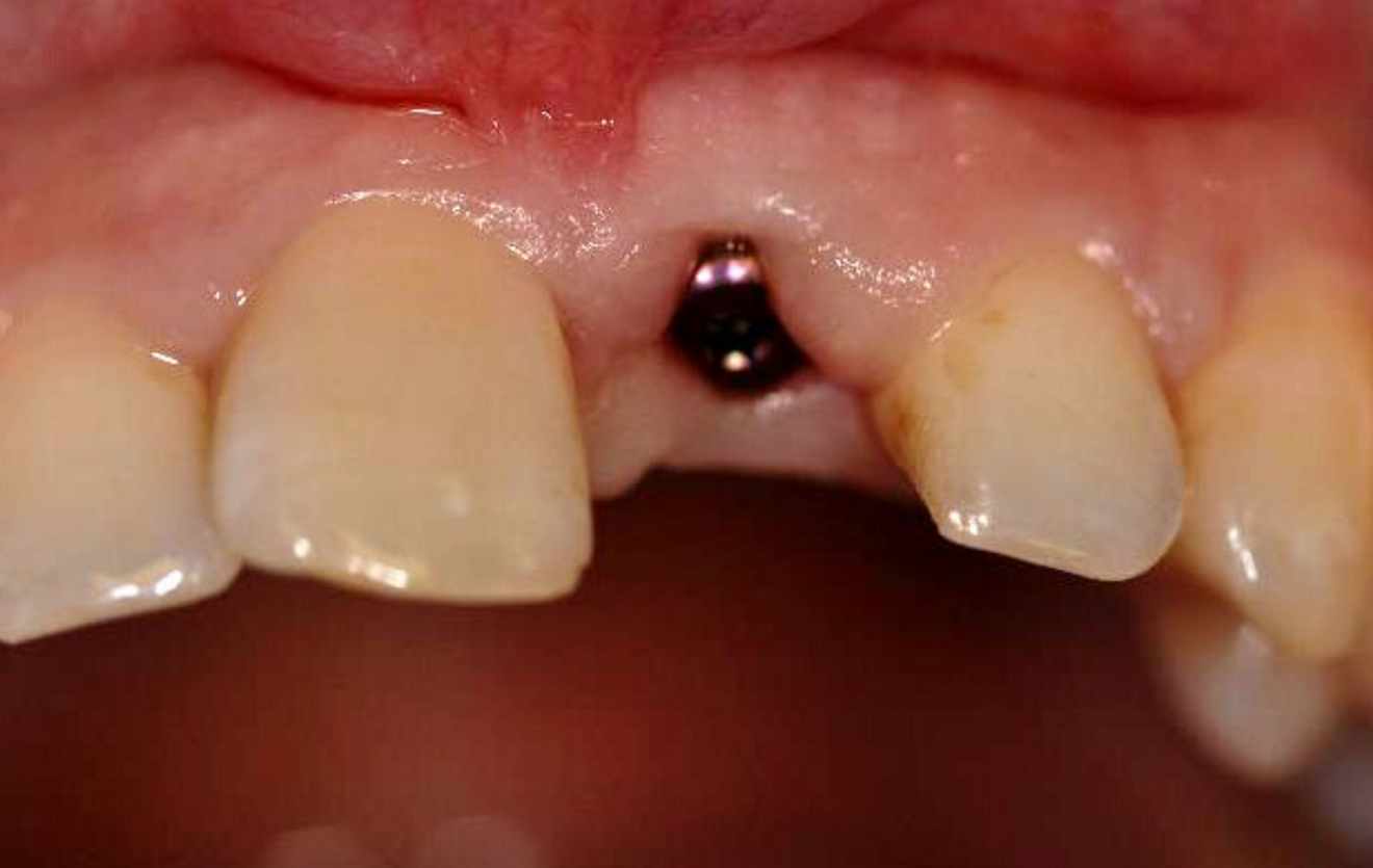 Healing abutment (e) ...
