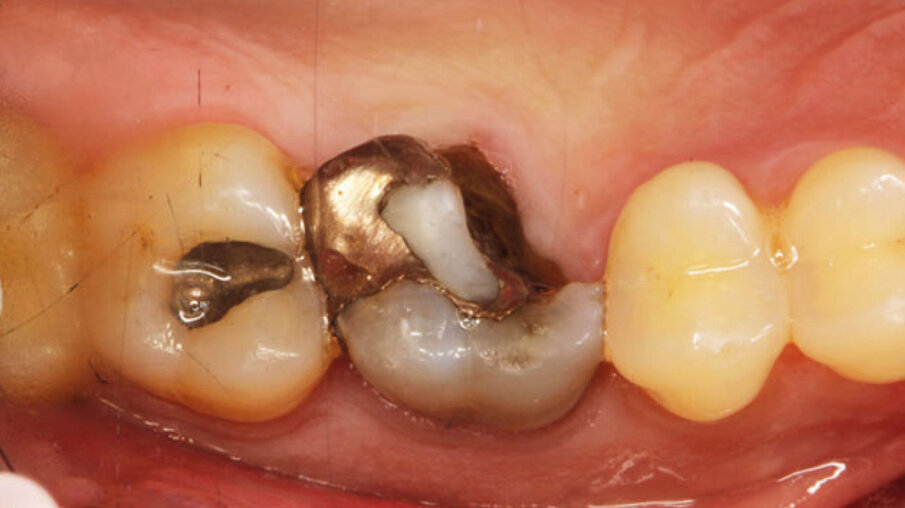 Fig. 1a_Foto iniziale occlusale.