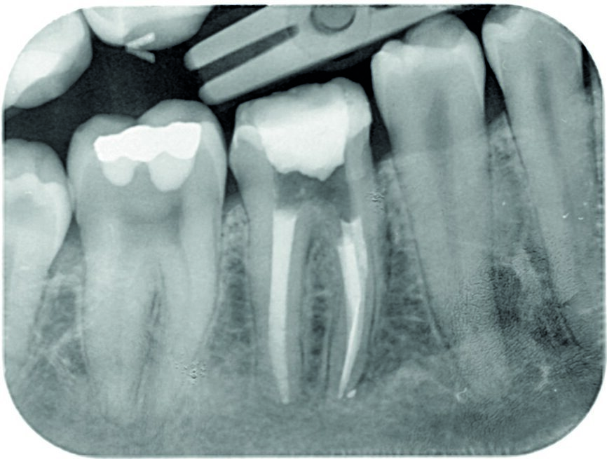 Fig. 5: Control radiograph after final obturation