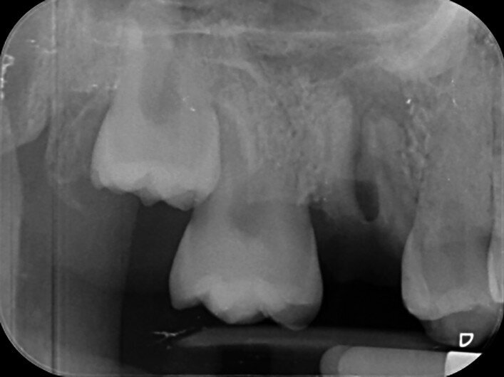 Fig. 19a: Radiographs: Pre-op periapical.