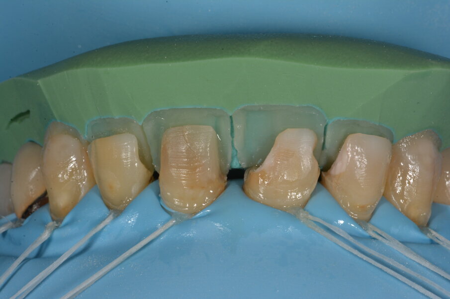 Eerst wordt een dunne laag 3M Filtek Universal Restorative aangebracht op de putty en uitgestreken met een kwastje om de kans op luchtbellen te verkleinen.