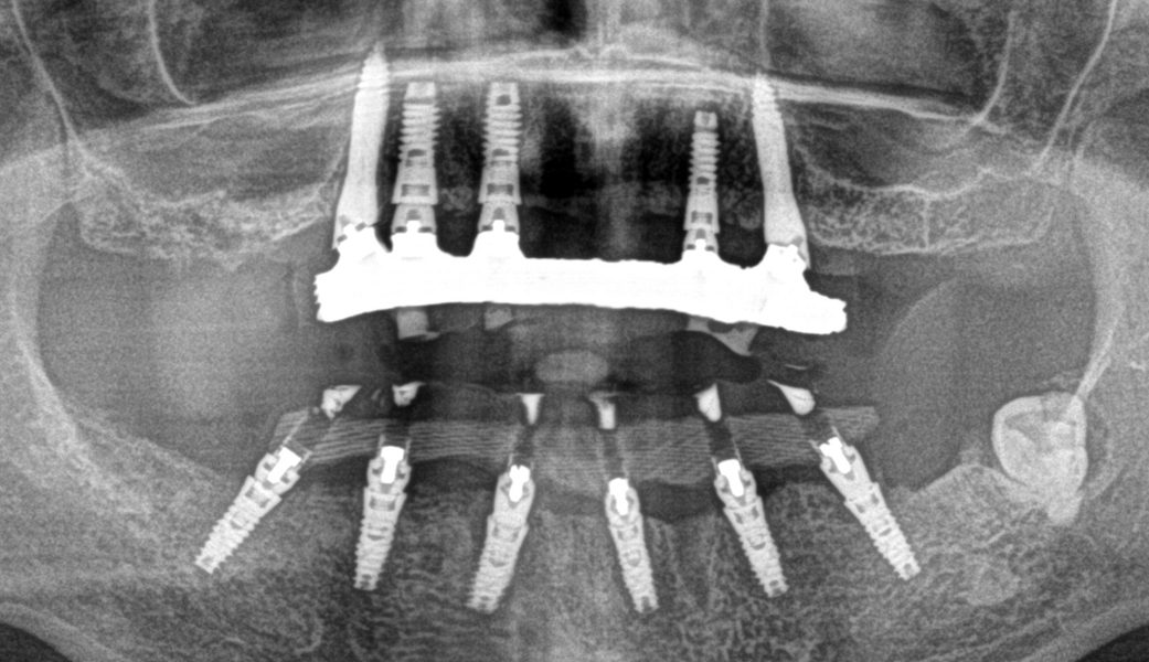 Fig. 6 : Contrôle postopératoire.