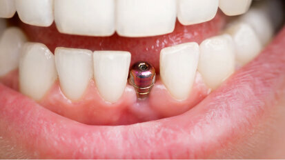 Journal celebrates centennial with article on how implants have influenced restorative dentistry Journal celebrates centennial with article on how implants have influenced restorative dentistry