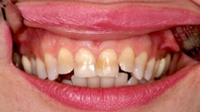 Rehabilitación de dientes anteriores con carillas CAD/CAM