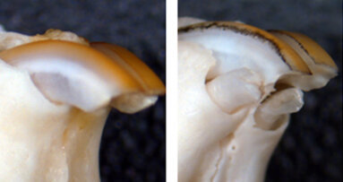 Kaybedilen Dişler Yeniden Çıkabilir mi?