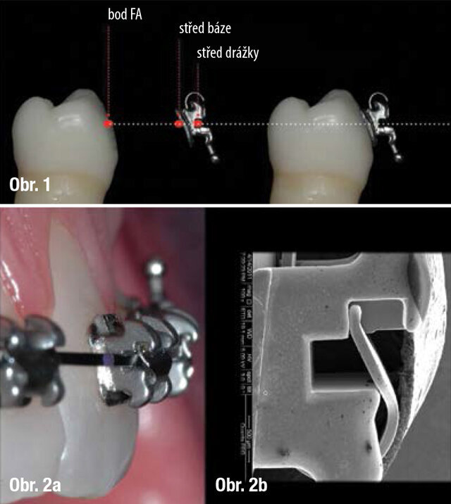 Obr. 1: Ukazuje ideální vztah mezi středem drážky, středem báze zámku a bodem FA (střed klinické korunky okluzogingiválně v dlouhé ose korunky zubu)  Obr. 2a: Ukazuje zblízka In-Ovation ‘R’ zámek s obloukem .020” × .020” Bioforce. Aktivní dvířka již začala tlačit oblouk do drážky, začíná se vyjadřovat torze.  Obr. 2b: Ukazuje fotografii zámku In-Ovation ‘R’ z elektronového mikroskopu (pořízena členy autorova kolektivu na University of Pennsylvania jako součást výzkumu). Je možné si lépe prohlédnout tvar zámku – design drážky a dvířek.