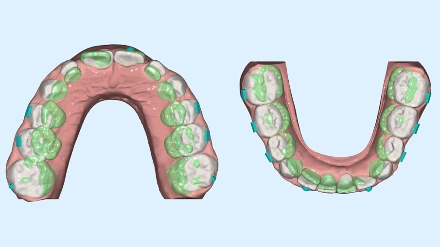 Fig. 6_Confronto prima e dopo della programmazione sul piano trasverso.