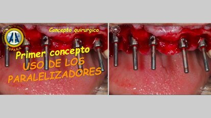 Implantología simple y eficaz