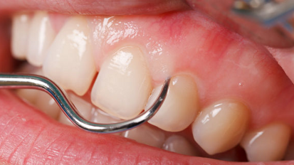 Les cellules souches gingivales pourraient être utilisées dans la régénération tissulaire