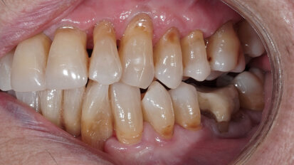 Fig. 3: Open bite in the mandibular left posterior region.