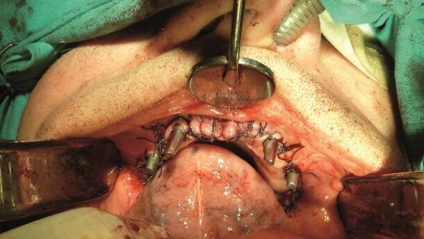 Rekonstrukcja implantoprotetyczna bezzębia szczęki