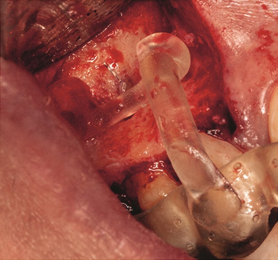 Fig. 2i: Separated instrument out of the root near the apical area of tooth #15.