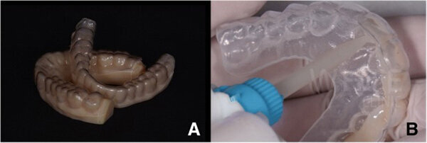 Fig. 5. a Matriz para el mock-up motivacional y modelos digitales. b Mock-up motivacional hecho de bisacryl (Structur, VOCO).