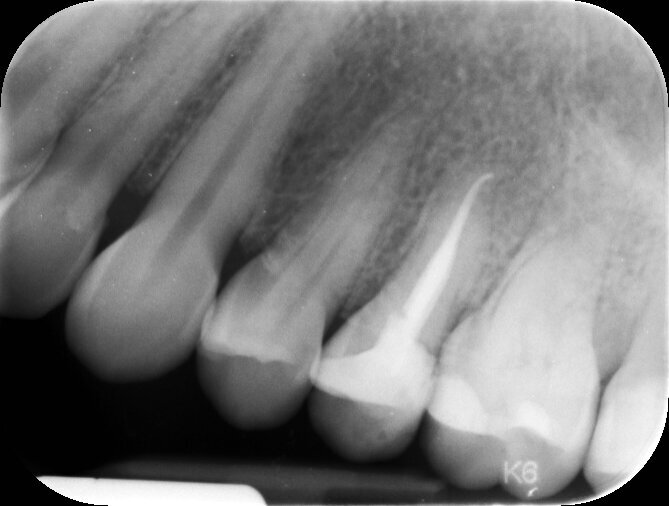 Fig. 2_Rx endorale eseguita con centratore, si evidenzia una buona disponibilità ossea periradicolare. Non si ascrivono alterazioni radicolari.