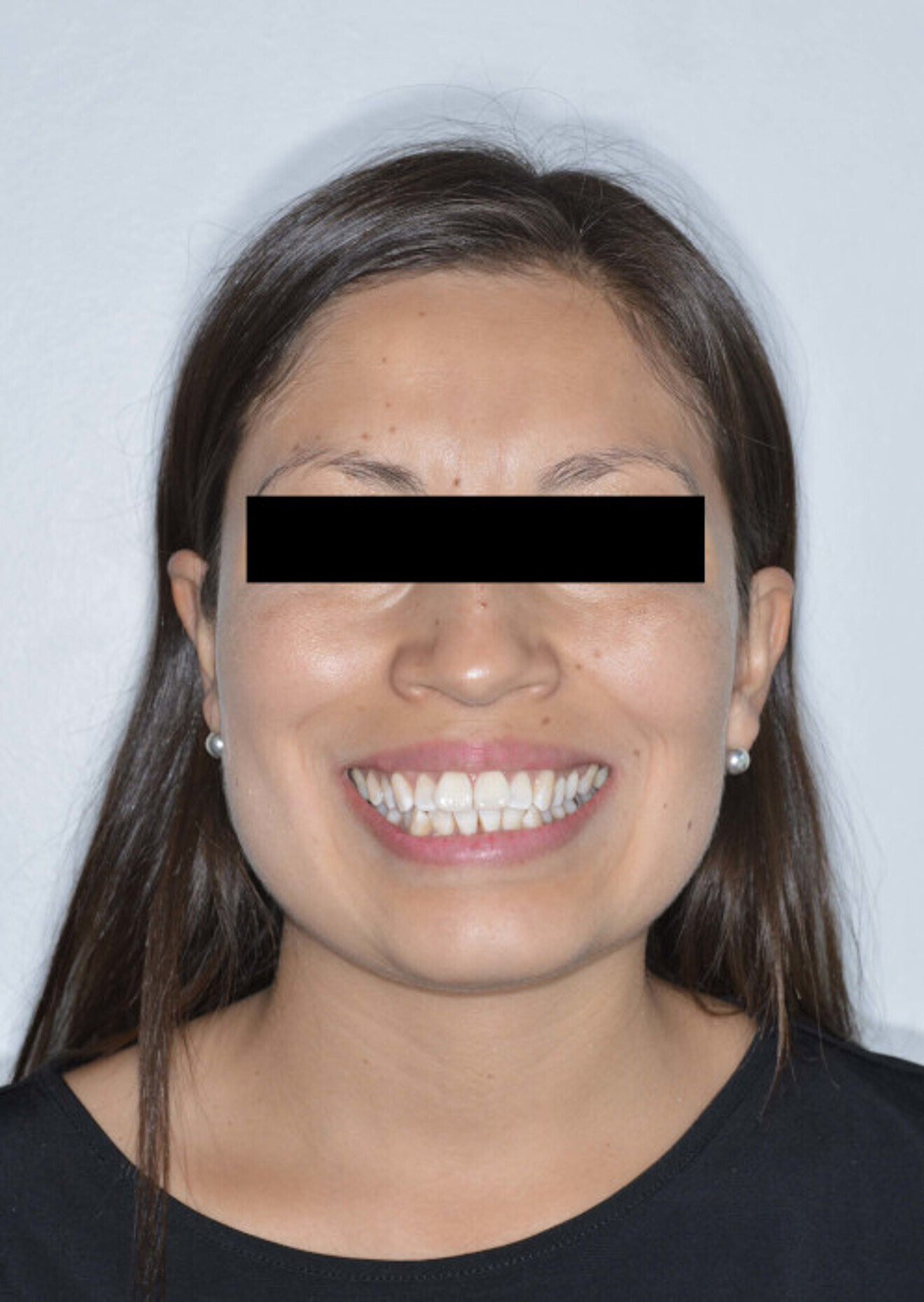 Fig. 12a: Smile comparison before ...