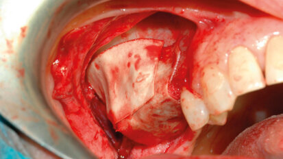 Criteri di prevedibilità nell’aumento dei volumi ossei: biomateriali o sostituti ossei?