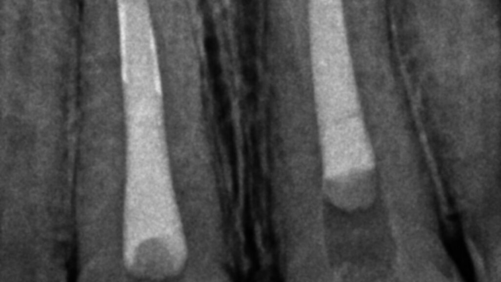 Irrigating the root canal: A case report