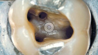 Le nuove punte da ultrasuoni per la rifinitura della cavità d’accesso A-C Tips