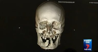 Австралийски хирурзи възстановяват лицето на мъж след инцидент с резачка за дърва