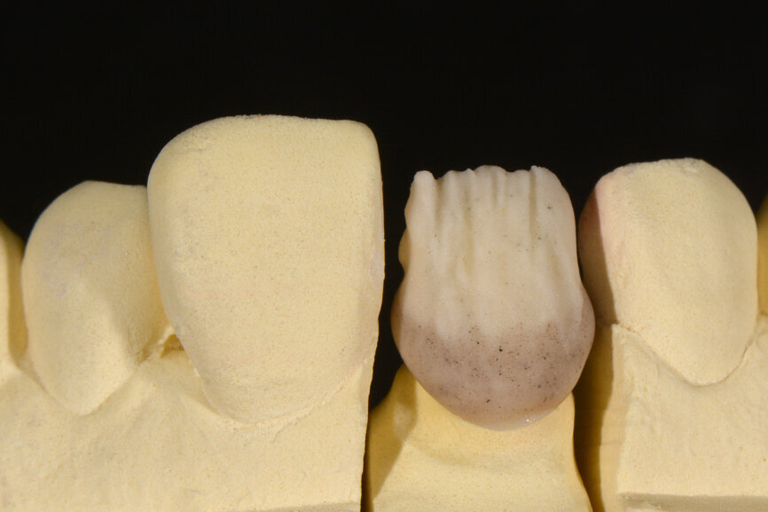 Fig. 4. La fluorescencia cervical (rojiza/pardusca) se logró mediante EL3, y para un efecto incisal más claro se empleó EL1.