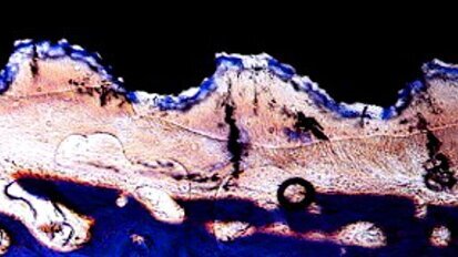 Lettre d’opinion : implants paro-intégrés, réalité ou fiction ?