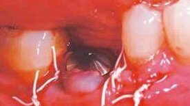 Implantacja natychmiastowa implantu NanoTite™ PREVAIL® z jednoczesnym przeszczepem kostnym