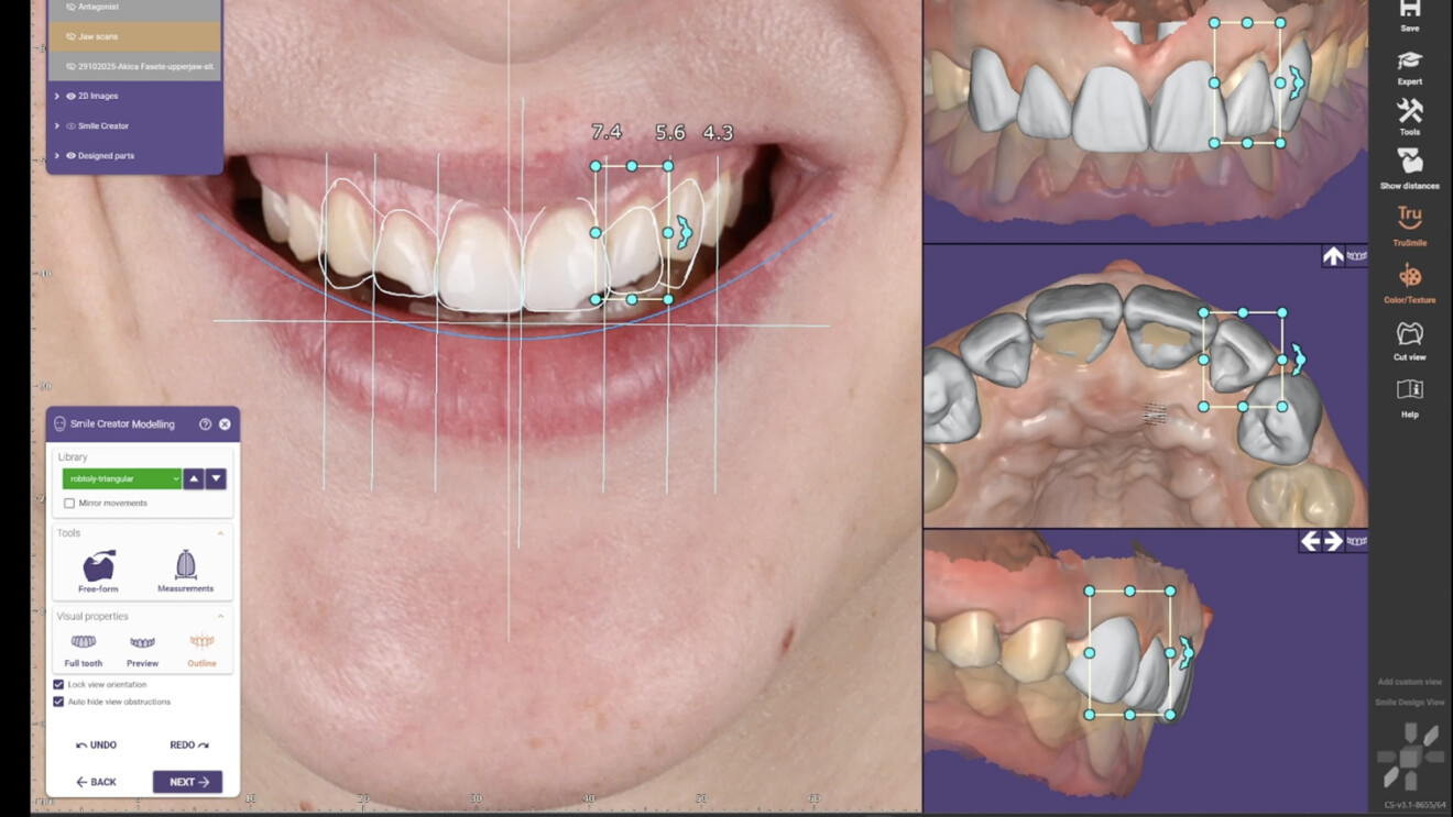 Fig. 2a: Digital planning of the proposed maxillary anterior veneers. Digital smile design based on the patient’s smile and intra-oral scan data.