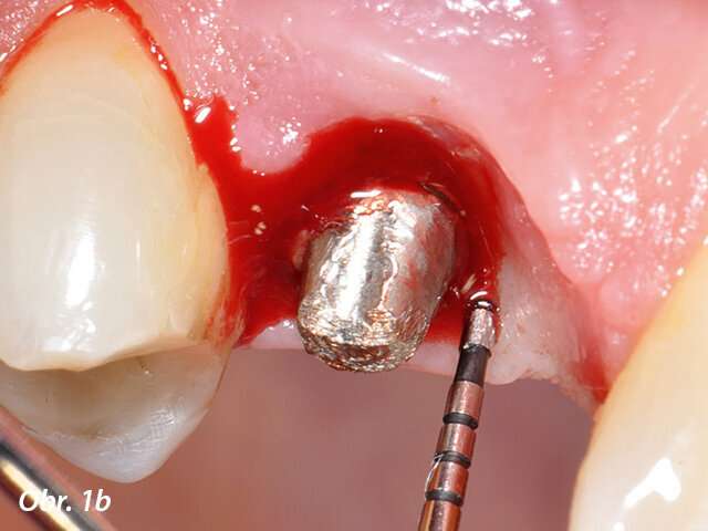 Periimplantitidou postižený implantát v pozici zubu 14 s patrnou patologickou hloubkou sondáže: b) stav po sejmutí korunky