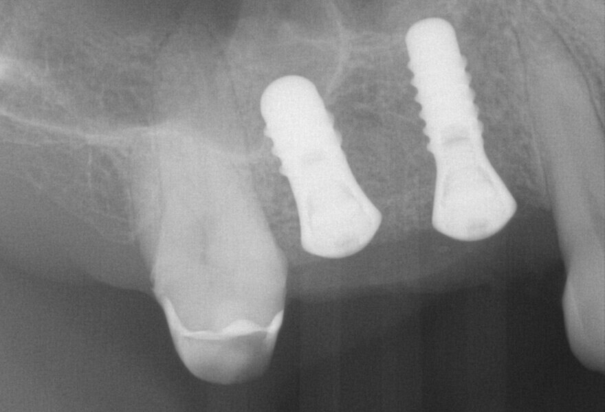 Fig. 12: Post-op radiograph showing the implants in regions #14 and 15.