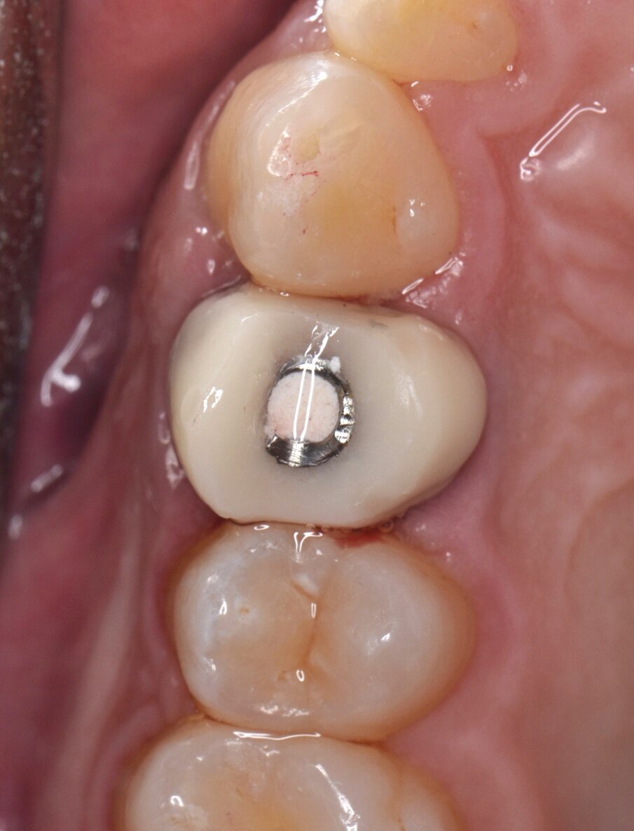 Fig. 17 - Corona provvisoria in resina ribasata sul moncone provvisorio (visione occlusale).