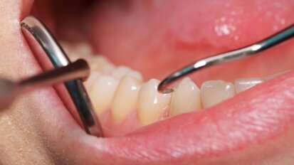 Slechte mondhygiëne beïnvloedt mogelijk covid-19-test