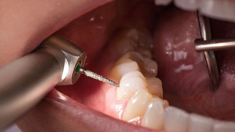 La posición del LED en el cabezal de la turbina garantiza la mejor visibilidad e iluminación del lugar de tratamiento. Foto: © W&H