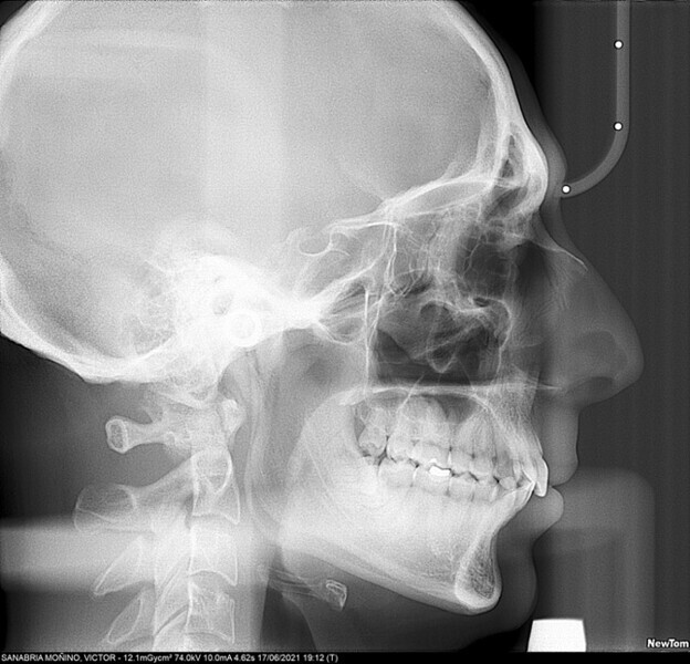 Fig. 26: Cephalometric radiograph taken four years after treatment.