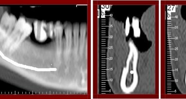 Cirugías complementarias para la modificación ósea de la mandíbula atrófica