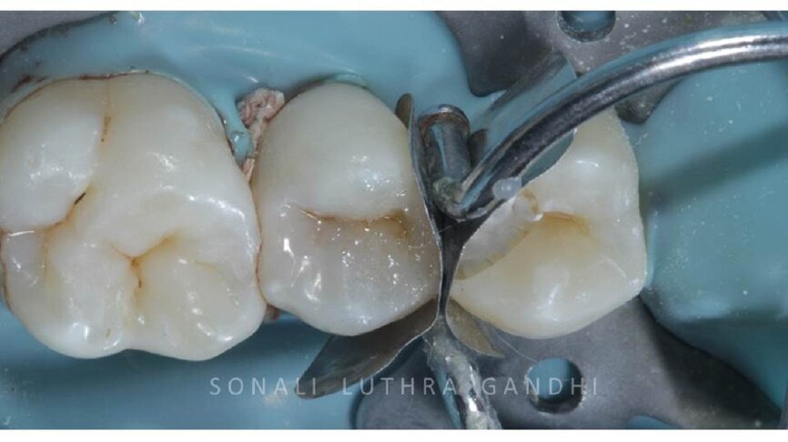 Figure 9 Build up complete