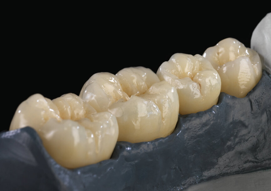 Zolid Preshade feierte 2013 seine Premiere und war der erste voreingefärbte Zolid-Rohling. © Amann Girrbach