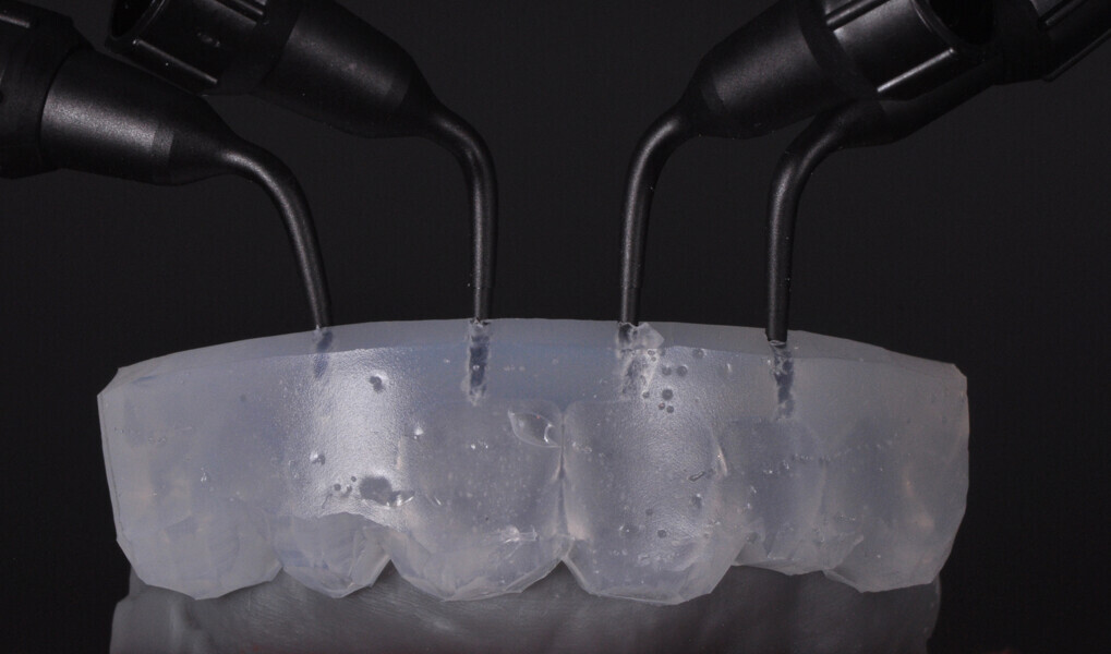 Fig. 6: Transparent matrix with injection holes produced for the build-up of the buccal enamel layer using the flowable injection technique.