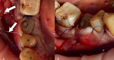 Poncho Lamina Technique: un nuovo approccio in un solo passaggio per l’aumento simultaneo del tessuto duro e molle in singoli siti implantari con atrofia ossea
