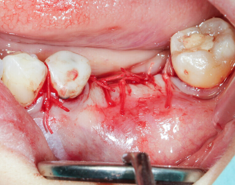 Fig. 7: A #4/0 rapidly resorbed braided thread was used for the sutures.