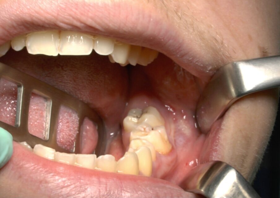 Fig. 2_Situazione clinica iniziale 3.8 in inclusione orizzontale.