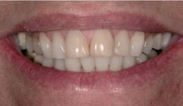 Afbeelding 1-4: Mondfoto’s en intraorale scans. In een eerste bezoek werd de wens met de patiënt besproken en werd er een aantal mondfoto’s gemaakt.