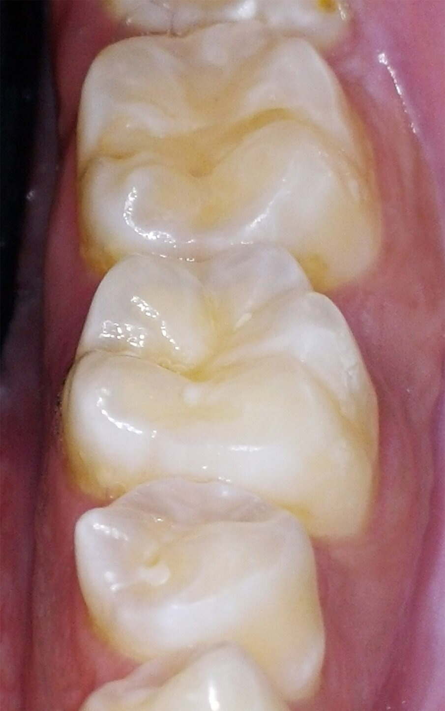 Molar tooth