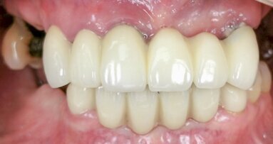 Maxillary full-arch implant-supported rehabilitation with a digital workflow: Two-year follow-up