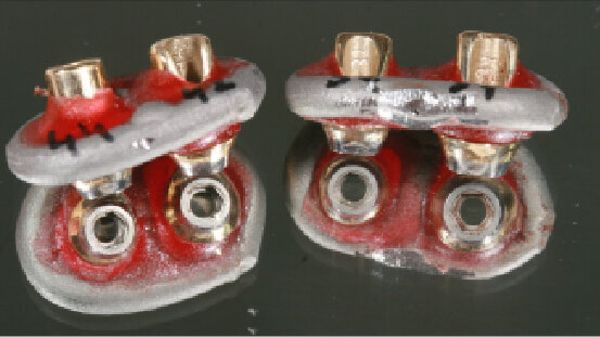 Náhrada nesená implantáty s využitím technologie teleskopů. Liviu Steier hovoří o hybridních protézách nesených implantáty