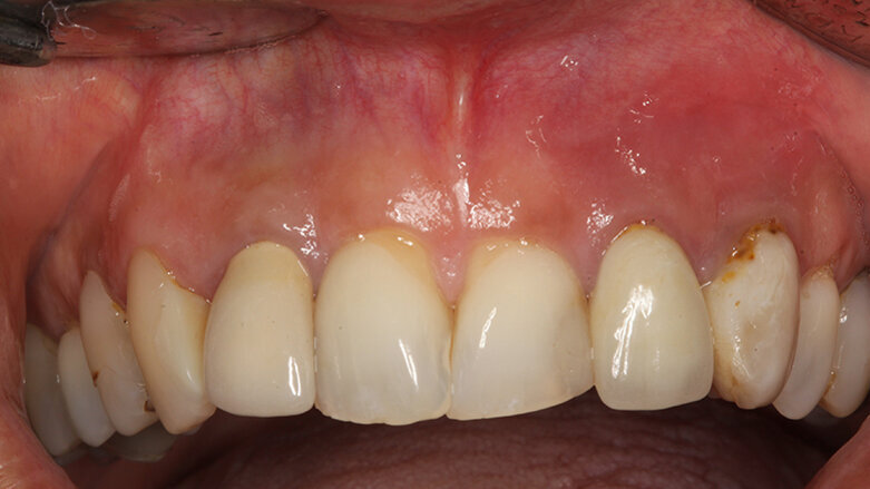 Cirugía periapical y regeneración ósea para un defecto apicomarginal en la zona estética