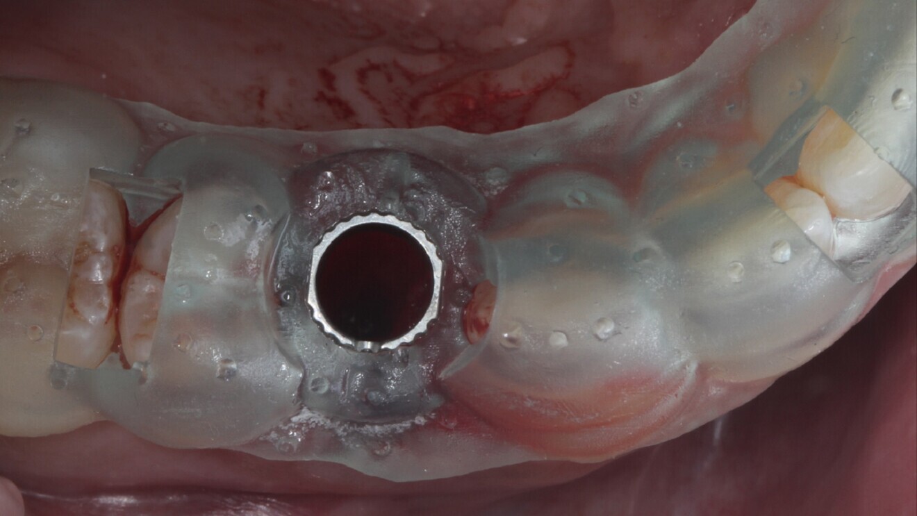 Fig. 8: 3D-printed surgical guide to guide implant placement in region #14.