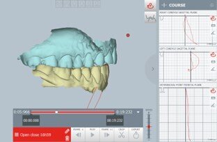 Figg. 9a-9d_La posizione di occlusione abituale, in visione frontale (a) e laterale (b). La posizione terapeutica ottenuta dopo la pianificazione digitale, riposizionando i condili in avanti e in basso e ricentrando la linea mediana, in visione frontale (c) e laterale (d). La posizione terapeutica è stata pianificata in tempo reale durante il check-up diagnostico 
della paziente, con un flusso di lavoro one-day completamente digitale